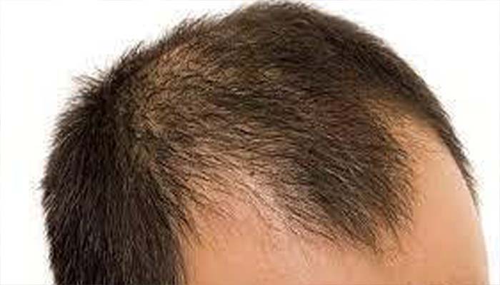 Are these mistakes of yours not becoming the cause of your baldness? What is the cause of hair loss?